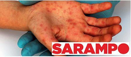 Leia mais sobre o artigo Sarampo: vamos perder a guerra contra esta doença também?