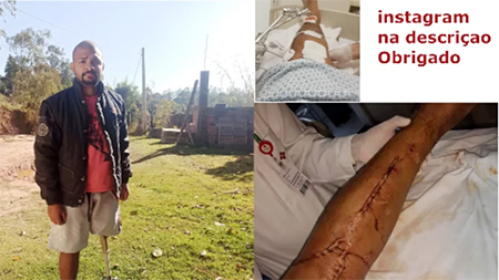 Leia mais sobre o artigo Silvano pede doação para sua nova perna mecânica para ele voltar a trabalhar