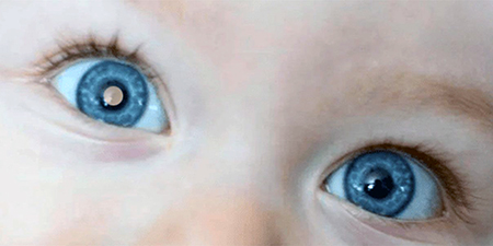Leia mais sobre o artigo Você já ouviu de retinoblastoma, um câncer que atinge os olhos de crianças?