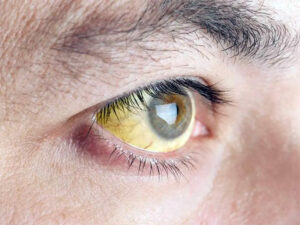 sintomas da febre amarela incluem icterícia