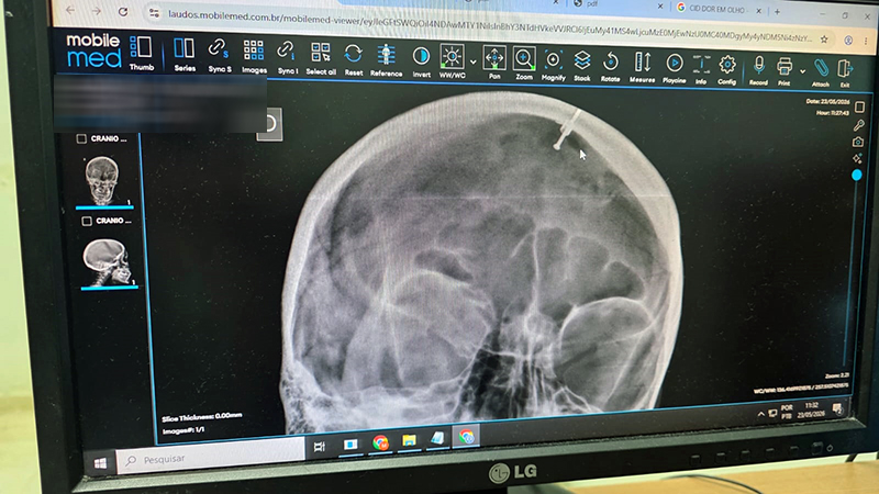 Mulher agredida por companheiro em Salto ficou com prego encravado no crânio